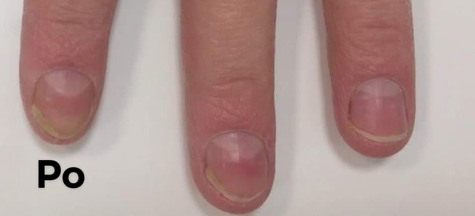 grzybica paznokcia rece po 2