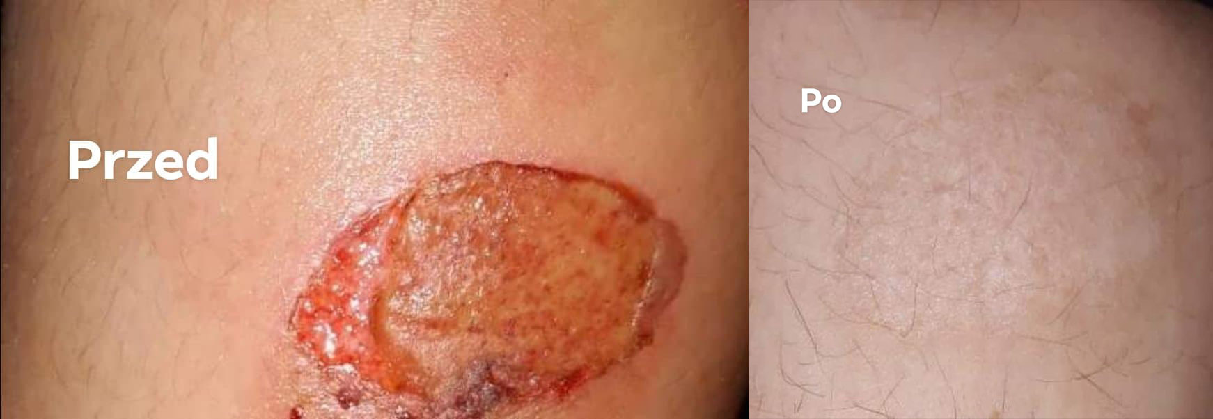 oparzenie kuracja nanosrebro przed i po