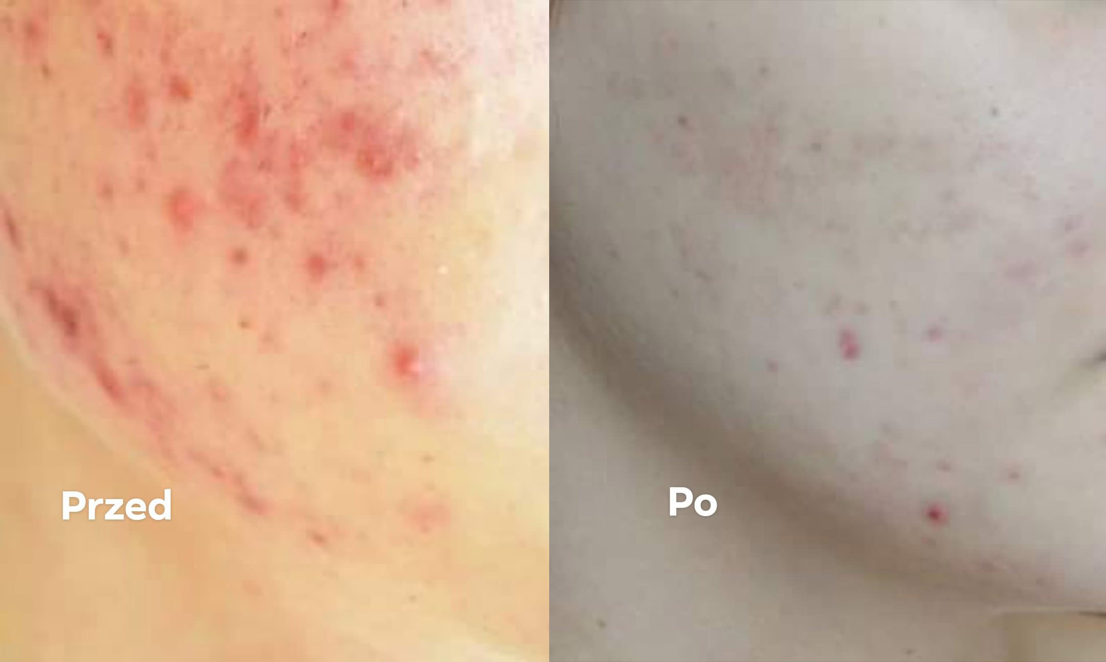 trądzik kuracja nanosrebro przed i po