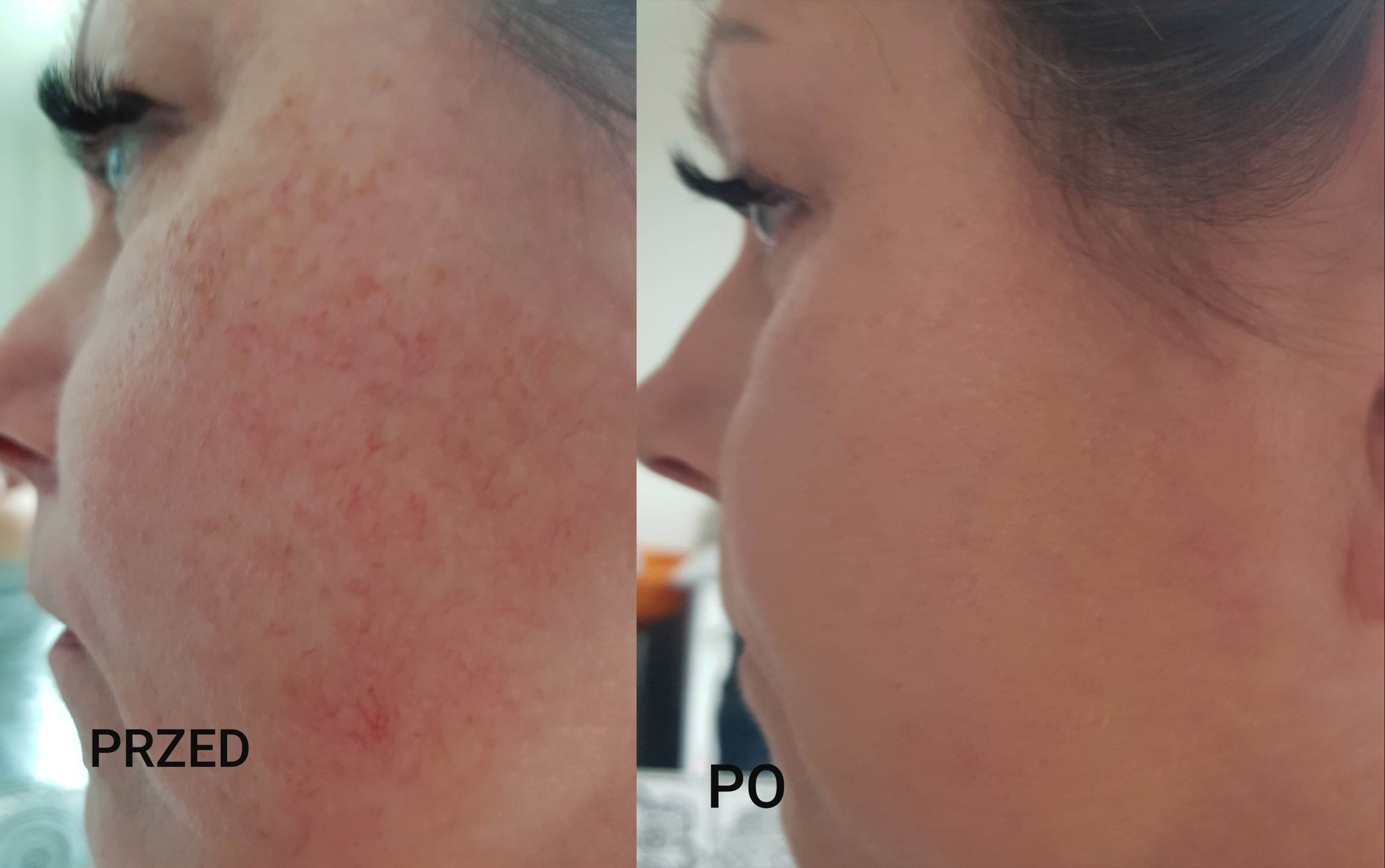 zdjęcie 1 przed i po