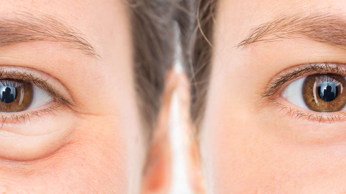 worki pod oczami baner