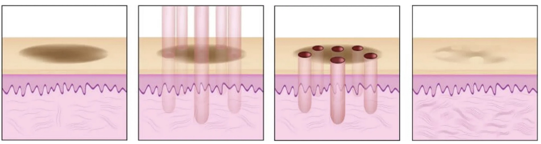 Jak działa laser frakcyjny CO2