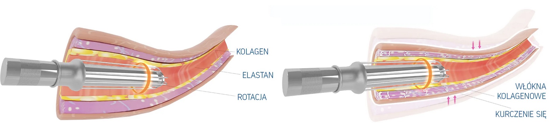 W jaki sposób zwęża się pochwę laserem frakcyjnym CO2