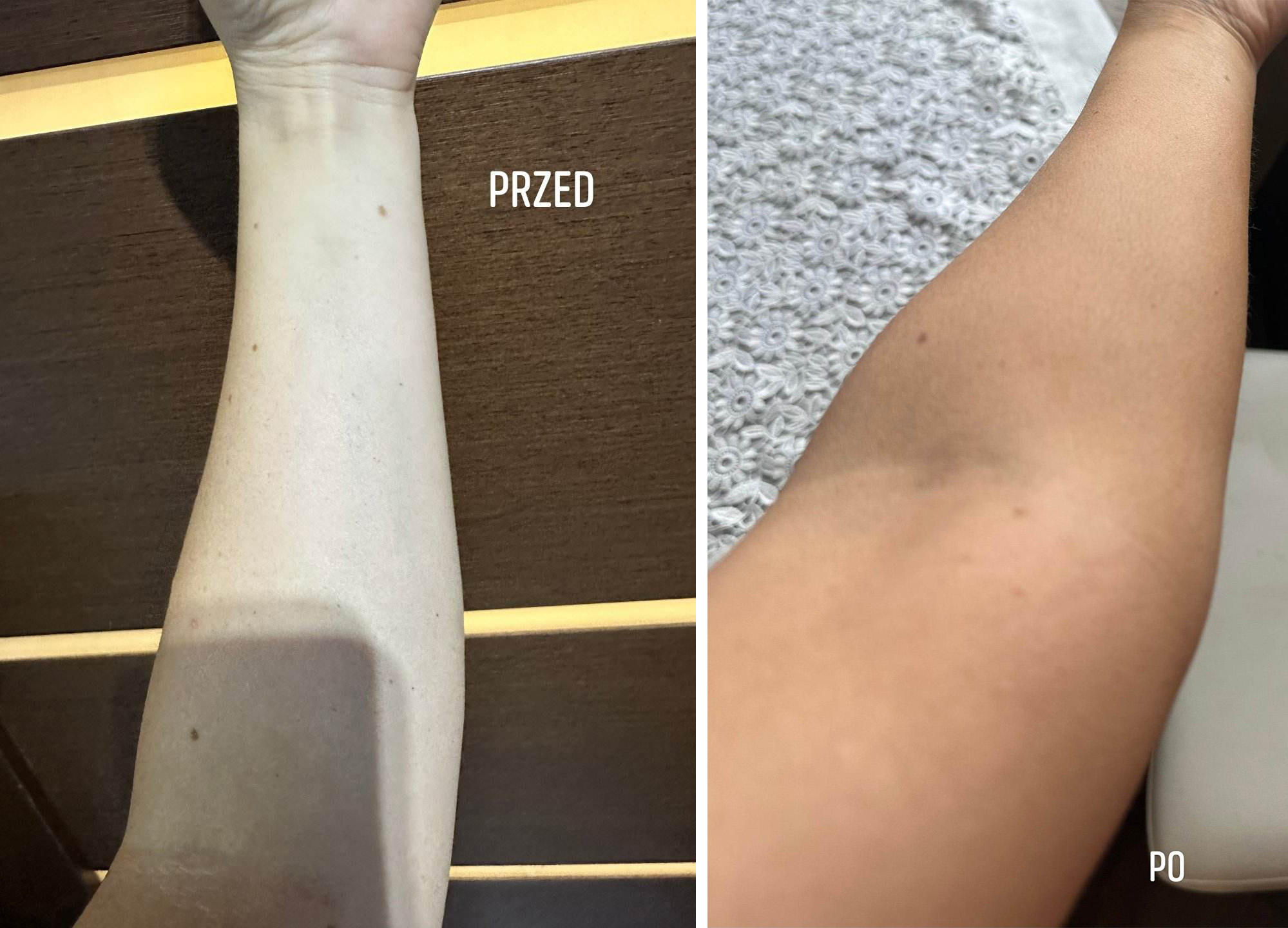bernadeta przed i po ręka