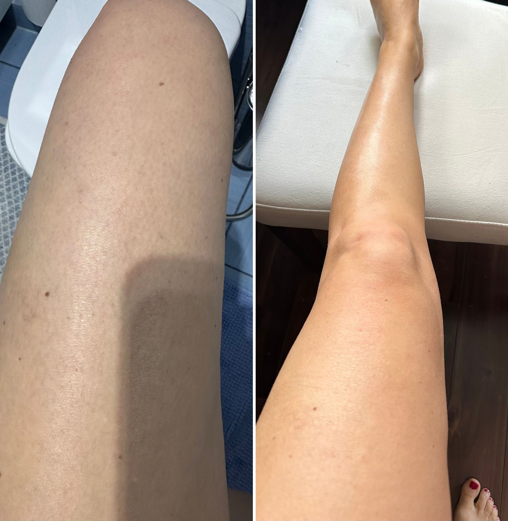 bernadetta przed i po noga