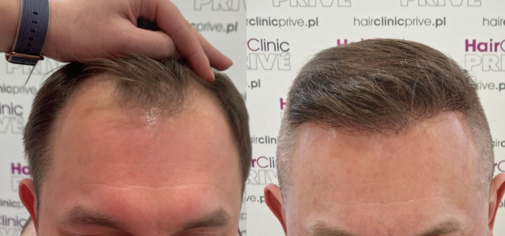 Przeszczep Wlosow FUE 1024x478