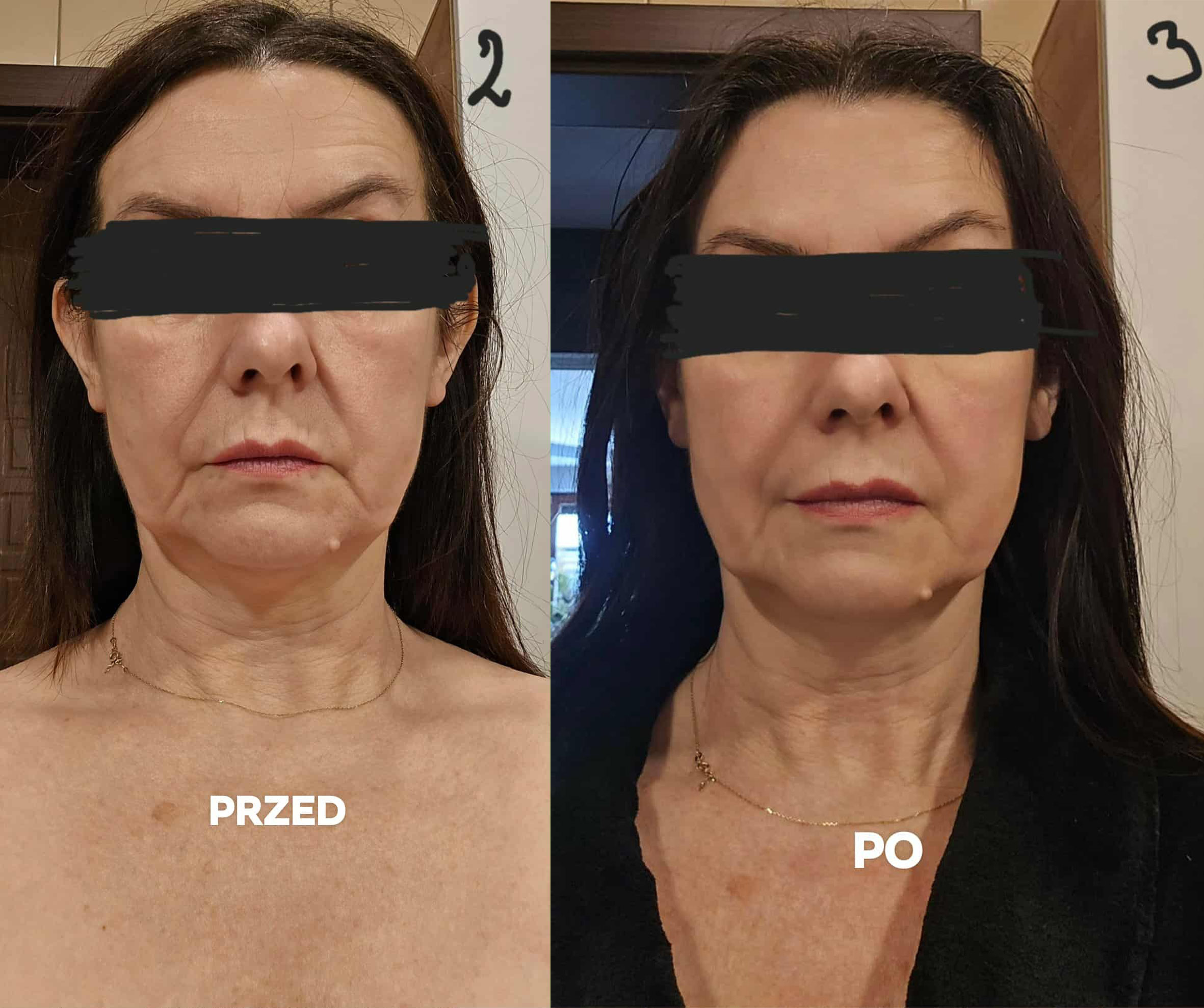 mona lab przed i po aga