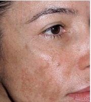 melasma
