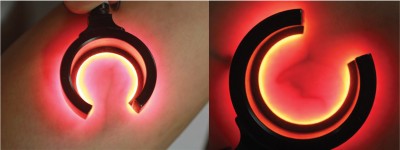 Fot. 1 Ocena drobnych naczyń krwionośnych za pomocą podświetlacza naczyniowego