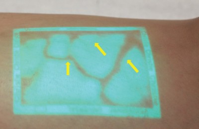 Fot. 2 Ocena drobnych naczyń krwionośnych za pomocą VeinViewer®. Strzałką oznaczono naczynia siatkowate i mniejsze teleangiektazje