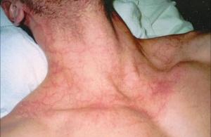 efekt_plazmatyczny_po_zastosowaniu_enzyme_masque_DMK