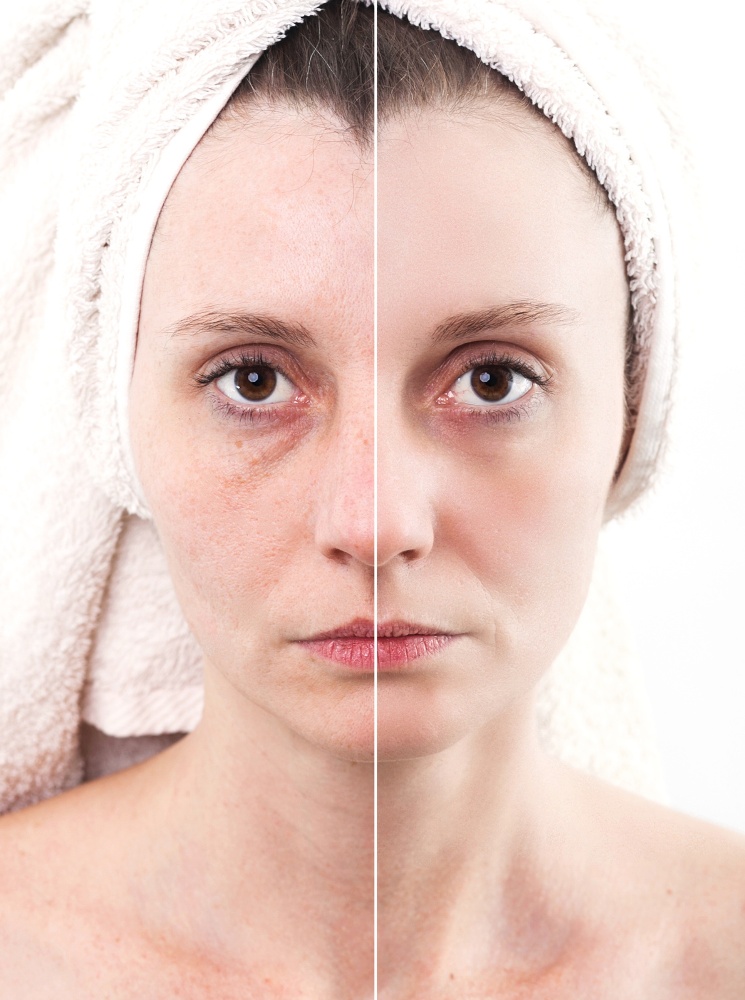 blizny zanikowe, usuwanie blizn, kosmetyka twarzy