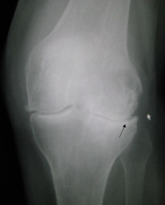 glukozamina osteoarthritis
