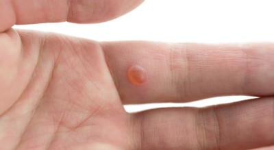 Fot. 1. Kurzajki to potoczna nazwa brodawek pojawiających się na skórze w wyniku zakażenia wirusem brodawczaka HPV (Human Papilloma Virus). Wirus ten ma wiele różnych odmian.