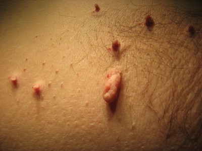 Fot. 2. Brodawki mogą występować niemal w każdej okolicy, najczęściej spotykane są ma skórze rąk, łokci, szyi, stóp i okolic narządów płciowych