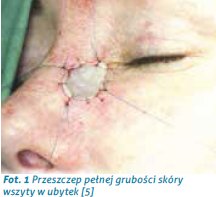 oparzenia2