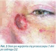 oparzenia4