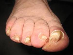 Podologia przeciw wrastaniu paznokci