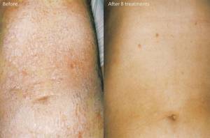 Lampa plasmowa fsl w walce z łuszczycą