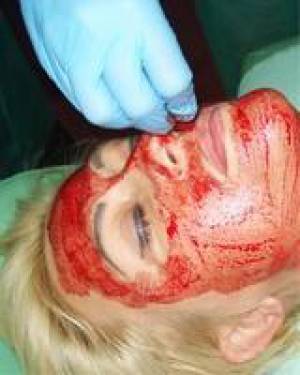 Zabiegi kosmetyczne z użyciem pijawek